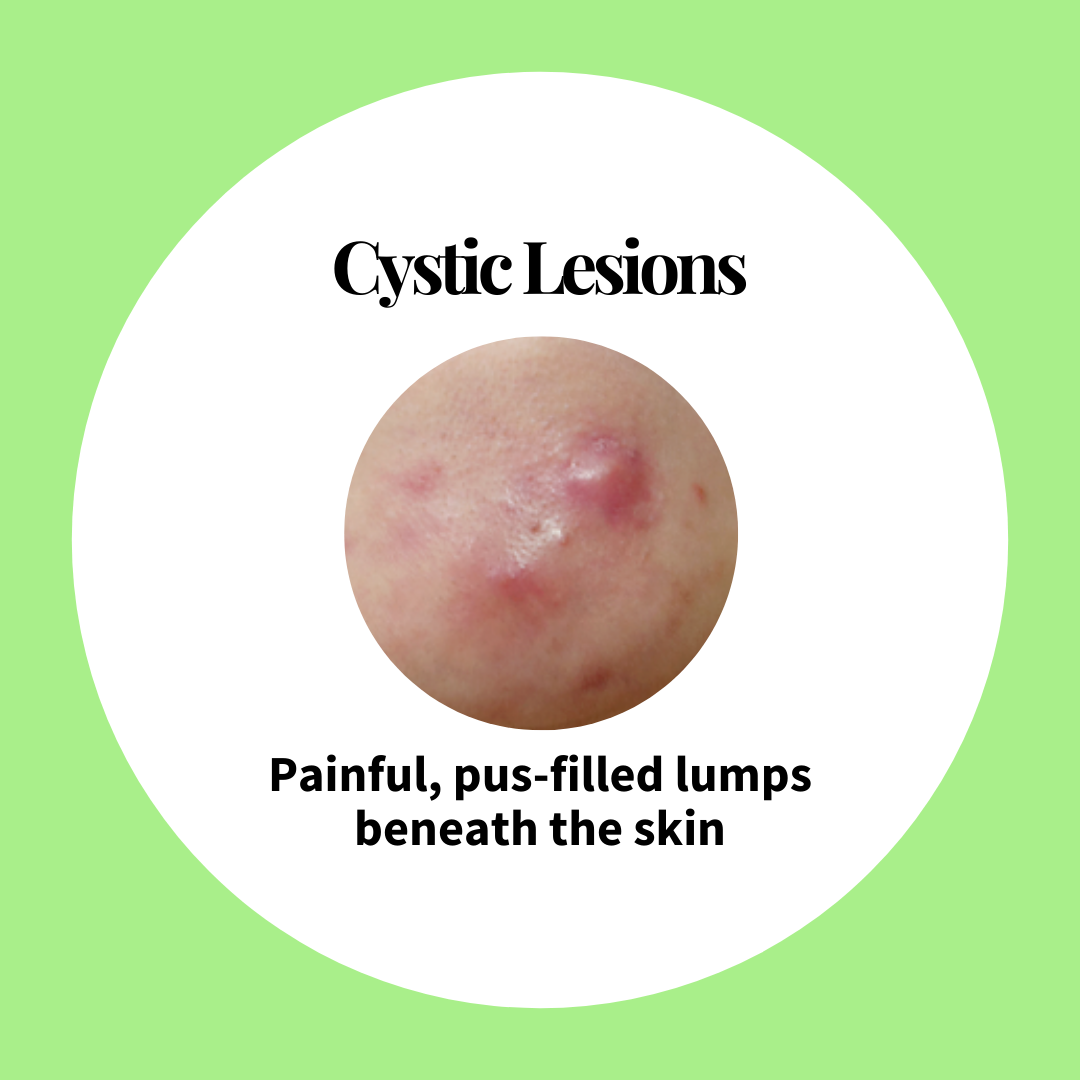 All About Acne Part 2 The Treatments Picky The KBeauty Hot Place