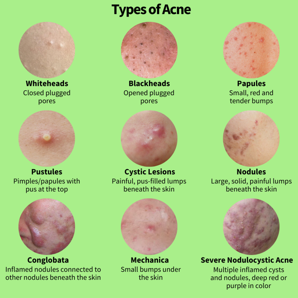 All About Acne Part 1 The Causes Picky The K Beauty Hot Place