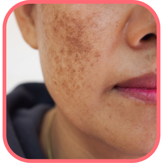 Melasma Vs Hyperpigmentation How To Spot The Difference Picky The