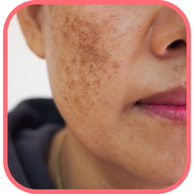 Melasma vs Hyperpigmentation: How To Spot The Difference