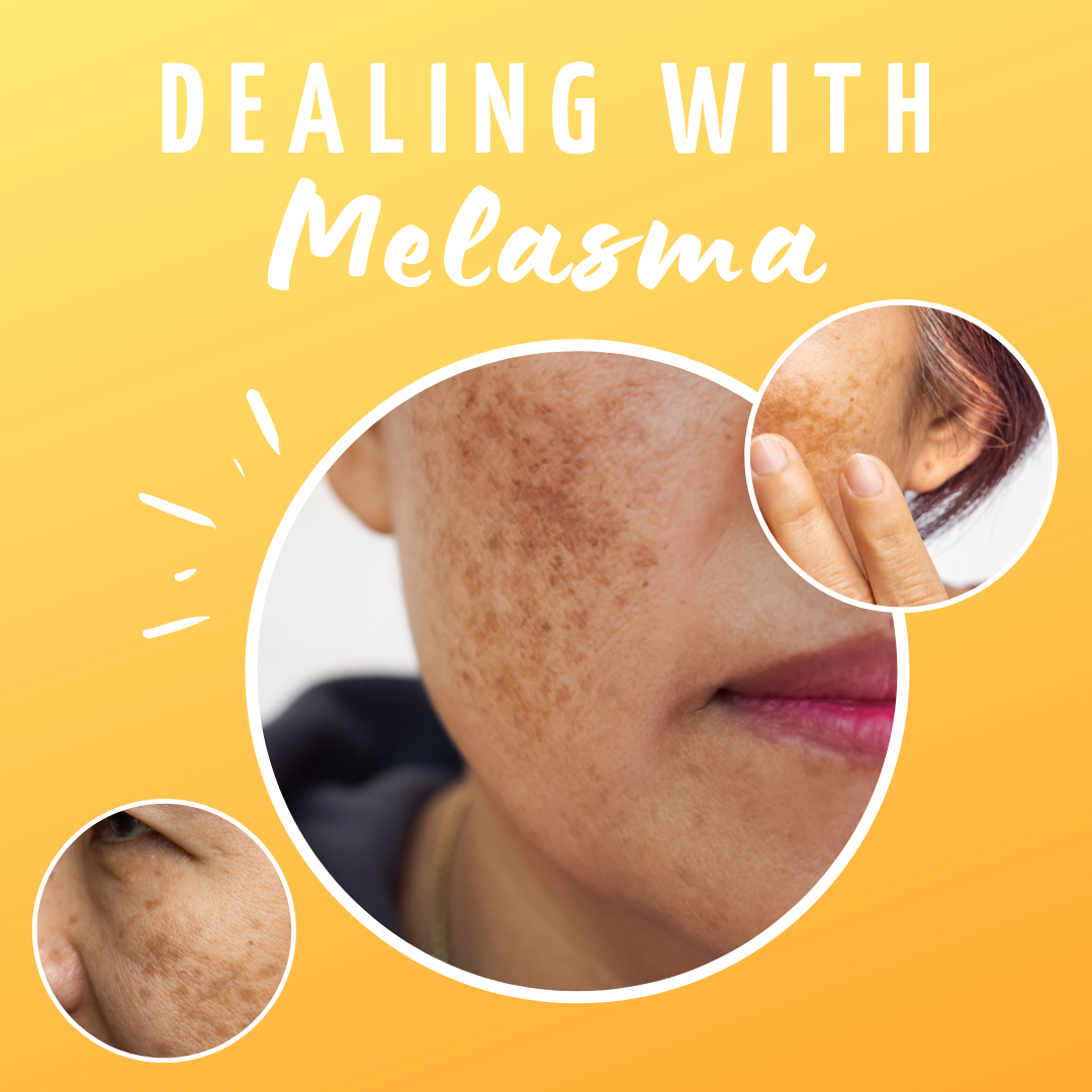 Melasma vs Hyperpigmentation: How To Spot The Difference